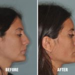 Rhinoplasty Before and After Photos in Miami, FL, Patient 226