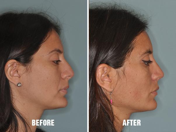 Rhinoplasty Before and After Photos in Miami, FL, Patient 226