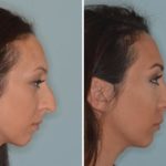 Rhinoplasty Before and After Photos in Miami, FL, Patient 714