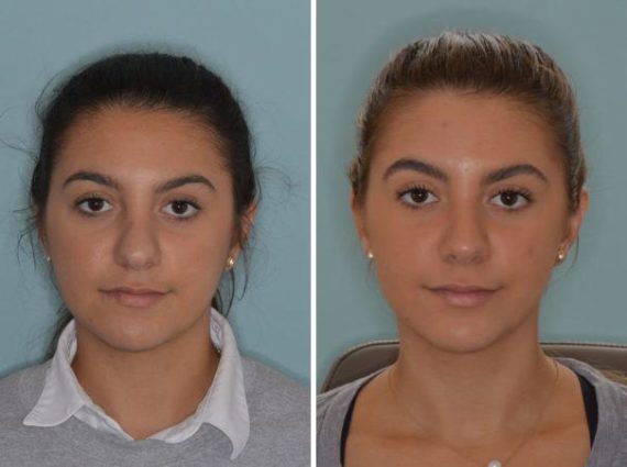 Rhinoplasty Before and After Photos in Miami, FL, Patient 717