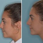 Rhinoplasty Before and After Photos in Miami, FL, Patient 717