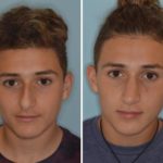 Rhinoplasty Before and After Photos in Miami, FL, Patient 724