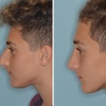 Rhinoplasty Before and After Photos in Miami, FL, Patient 724