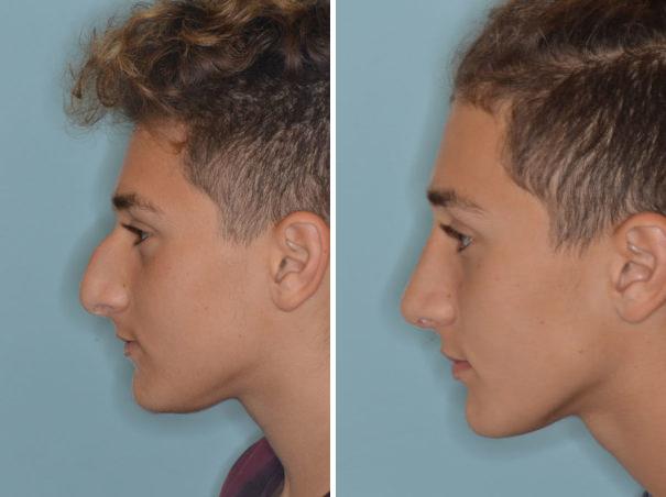 Rhinoplasty Before and After Photos in Miami, FL, Patient 724