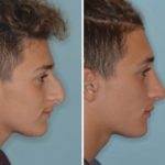 Rhinoplasty Before and After Photos in Miami, FL, Patient 724