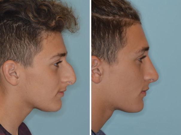 Rhinoplasty Before and After Photos in Miami, FL, Patient 724