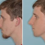 Rhinoplasty Before and After Photos in Miami, FL, Patient 734