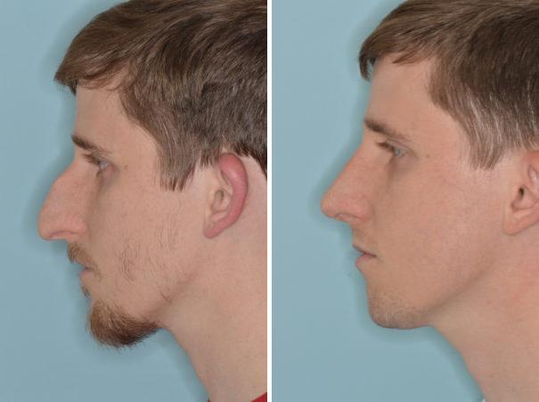 Rhinoplasty Before and After Photos in Miami, FL, Patient 734