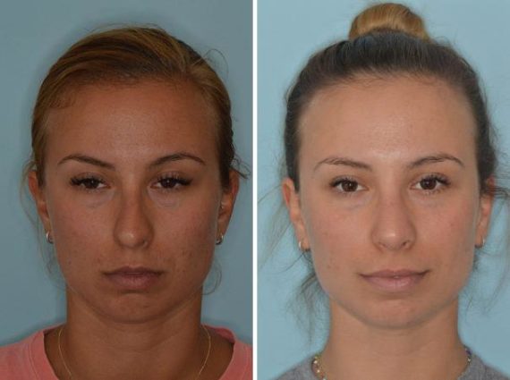 Rhinoplasty Before and After Photos in Miami, FL, Patient 741