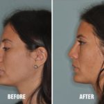 Rhinoplasty Before and After Photos in Miami, FL, Patient 226