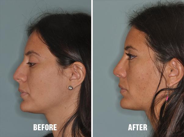 Rhinoplasty Before and After Photos in Miami, FL, Patient 226