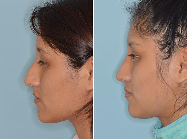 Rhinoplasty Before and After Photos in Miami, FL, Patient 752