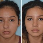 Rhinoplasty Before and After Photos in Miami, FL, Patient 759