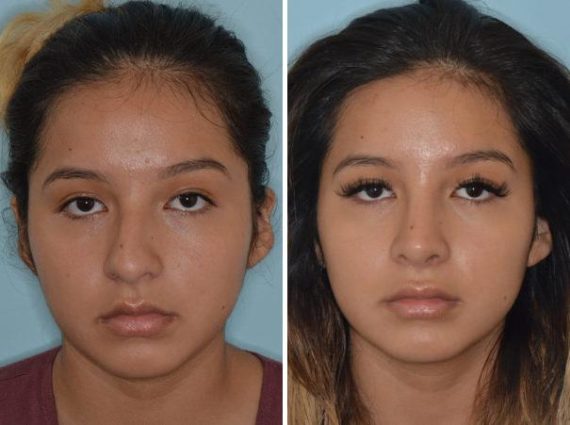 Rhinoplasty Before and After Photos in Miami, FL, Patient 759