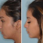 Rhinoplasty Before and After Photos in Miami, FL, Patient 759