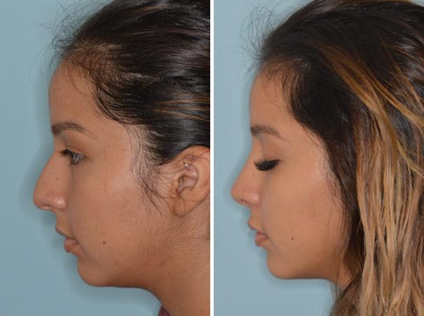 Rhinoplasty Before and After Photos in Miami, FL, Patient 759