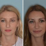 Rhinoplasty Before and After Photos in Miami, FL, Patient 766