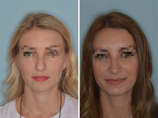 Rhinoplasty Before and After Photos in Miami, FL, Patient 766