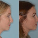 Rhinoplasty Before and After Photos in Miami, FL, Patient 766