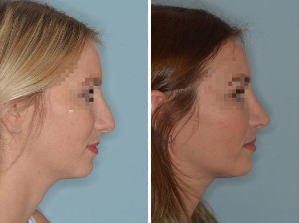 Rhinoplasty Before and After Photos in Miami, FL, Patient 766