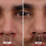 Rhinoplasty Before and After Photos in Miami, FL, Patient 239