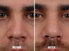 Rhinoplasty Before and After Photos in Miami, FL, Patient 239