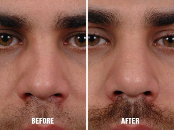 Rhinoplasty Before and After Photos in Miami, FL, Patient 239