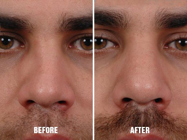 Rhinoplasty Before and After Photos in Miami, FL, Patient 239