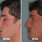 Rhinoplasty Before and After Photos in Miami, FL, Patient 174