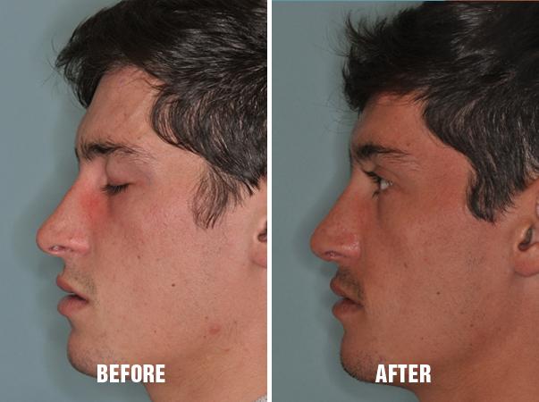 Rhinoplasty Before and After Photos in Miami, FL, Patient 174