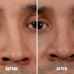 Rhinoplasty Before and After Photos in Miami, FL, Patient 251