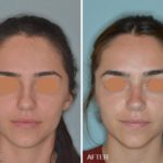 Rhinoplasty Before and After Photos in Miami, FL, Patient 255