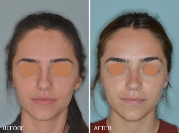 Rhinoplasty Before and After Photos in Miami, FL, Patient 255