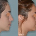 Rhinoplasty Before and After Photos in Miami, FL, Patient 255