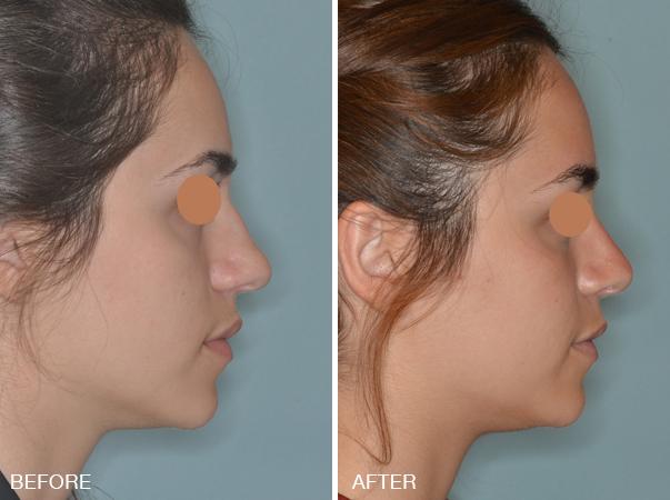 Rhinoplasty Before and After Photos in Miami, FL, Patient 255