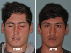 Rhinoplasty Before and After Photos in Miami, FL, Patient 174