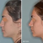 Rhinoplasty Before and After Photos in Miami, FL, Patient 255