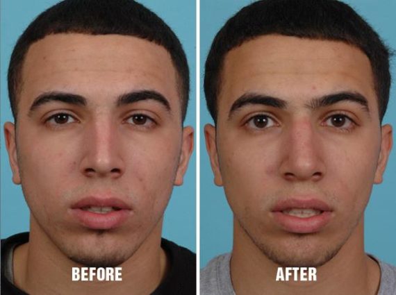 Rhinoplasty Before and After Photos in Miami, FL, Patient 268