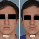 Rhinoplasty Before and After Photos in Miami, FL, Patient 184