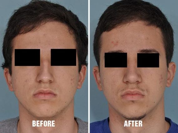 Rhinoplasty Before and After Photos in Miami, FL, Patient 184