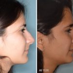 Rhinoplasty Before and After Photos in Miami, FL, Patient 278