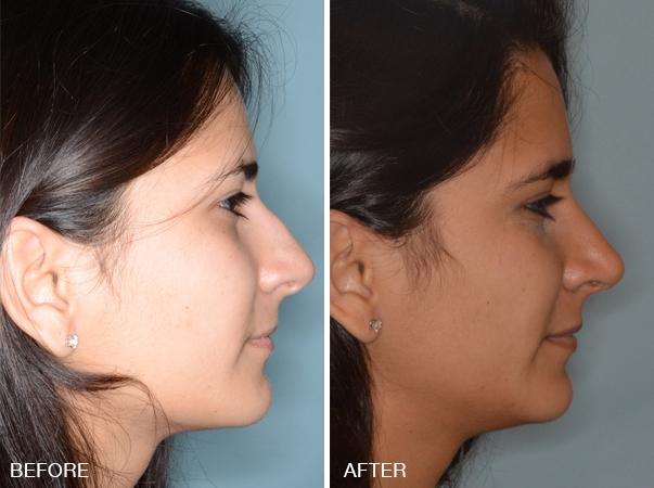 Rhinoplasty Before and After Photos in Miami, FL, Patient 278
