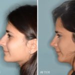 Rhinoplasty Before and After Photos in Miami, FL, Patient 278