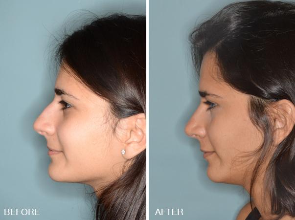 Rhinoplasty Before and After Photos in Miami, FL, Patient 278