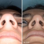 Rhinoplasty Before and After Photos in Miami, FL, Patient 278
