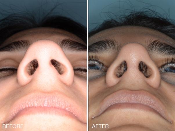 Rhinoplasty Before and After Photos in Miami, FL, Patient 278