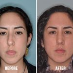 Rhinoplasty Before and After Photos in Miami, FL, Patient 298