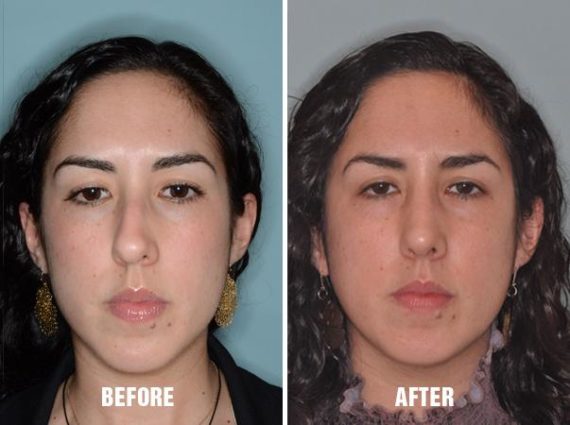 Rhinoplasty Before and After Photos in Miami, FL, Patient 298