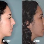 Rhinoplasty Before and After Photos in Miami, FL, Patient 298