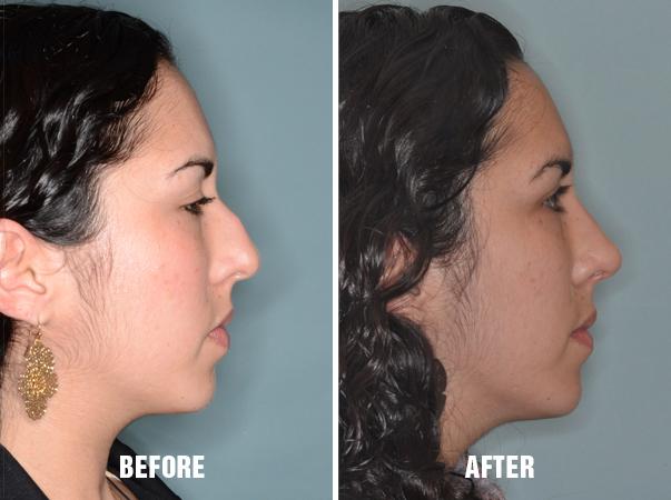 Rhinoplasty Before and After Photos in Miami, FL, Patient 298